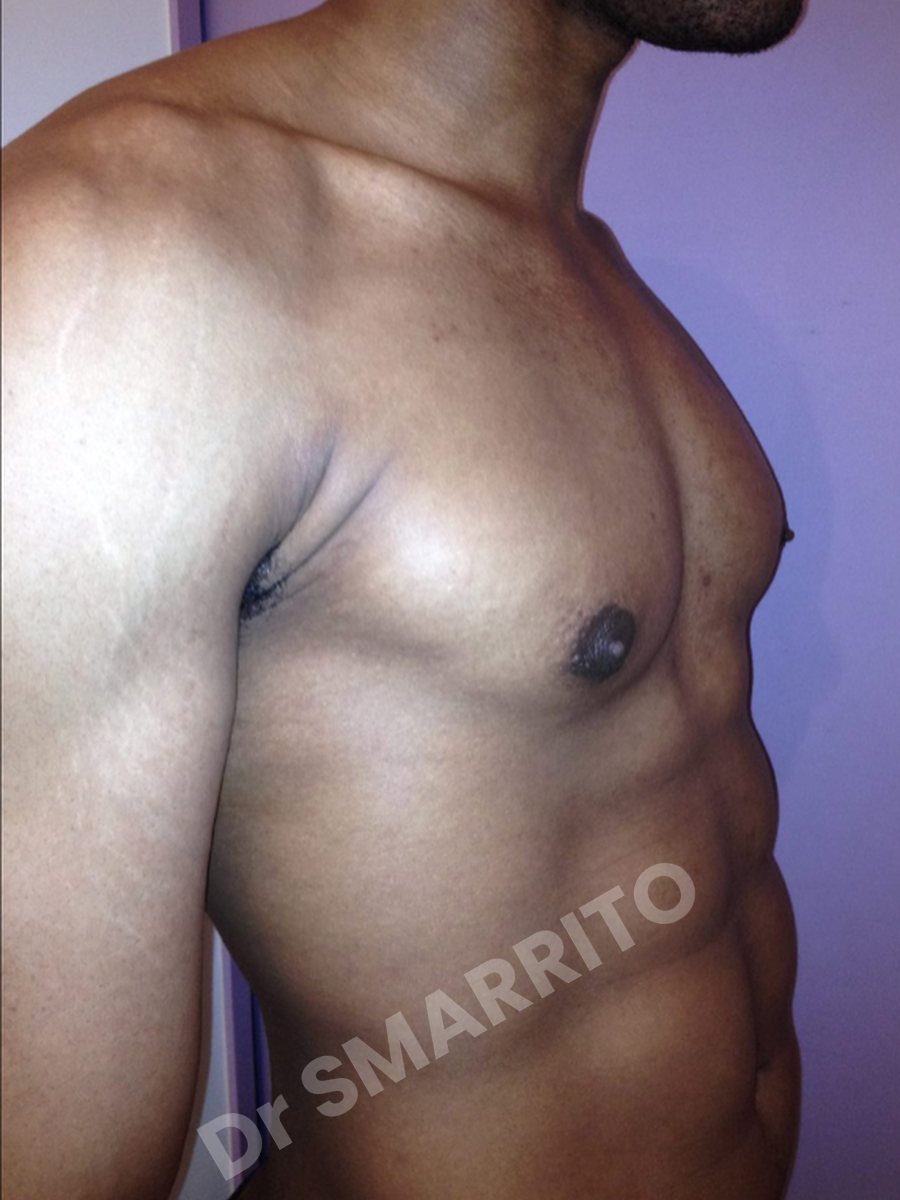 Gynécomastie après : torse, vue de trois-quarts, Dr Smarrito, chirurgie esthétique à Vevey