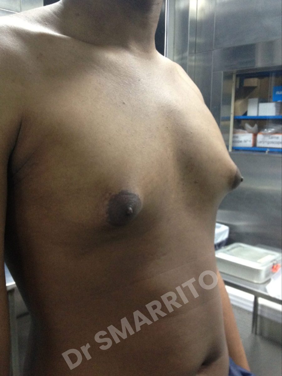 Gynécomastie avant : torse, vue de trois-quarts, Dr Smarrito, chirurgie esthétique à Vevey