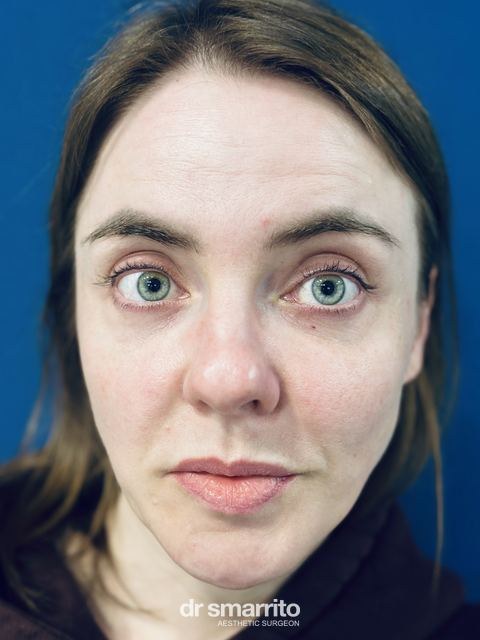 Après ProAge Eyes, chirurgie esthétique du regard – patiente 1 du Dr Smarrito