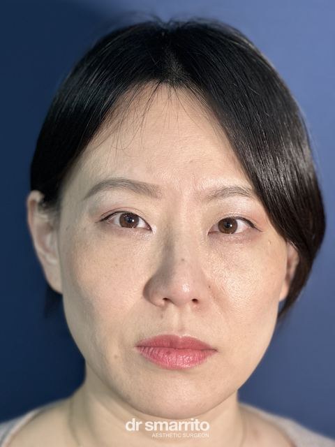 Après ProAge Eyes, chirurgie esthétique du regard – patiente 2 du Dr Smarrito