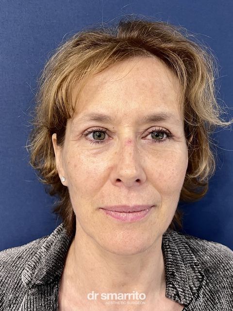 Après ProAge Eyes, chirurgie esthétique du regard – patiente 3 du Dr Smarrito
