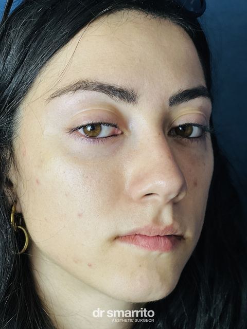 Après ProAge Eyes, chirurgie esthétique du regard – patiente 4 du Dr Smarrito