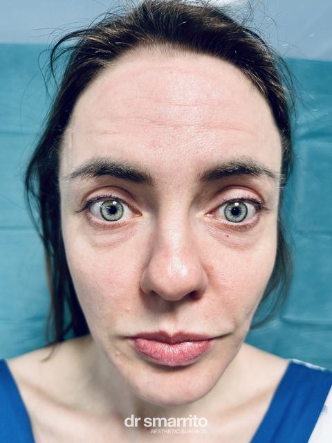 Avant ProAge Eyes, chirurgie esthétique du regard – patiente 1 du Dr Smarrito