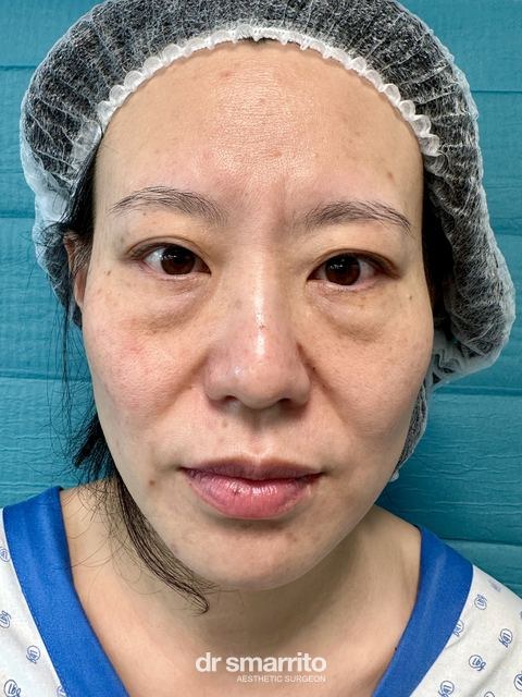 Avant ProAge Eyes, chirurgie esthétique du regard – patiente 2 du Dr Smarrito