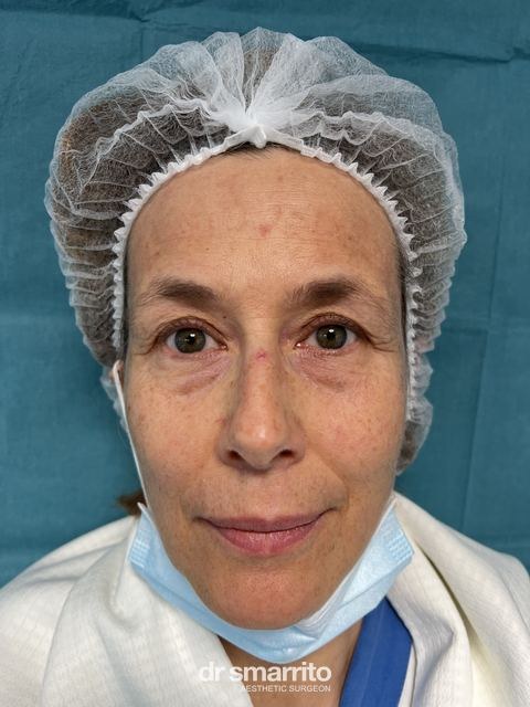 Avant ProAge Eyes, chirurgie esthétique du regard – patiente 3 du Dr Smarrito
