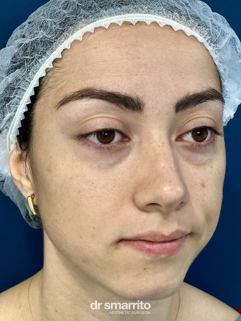 Avant ProAge Eyes, chirurgie esthétique du regard – patiente 4 du Dr Smarrito