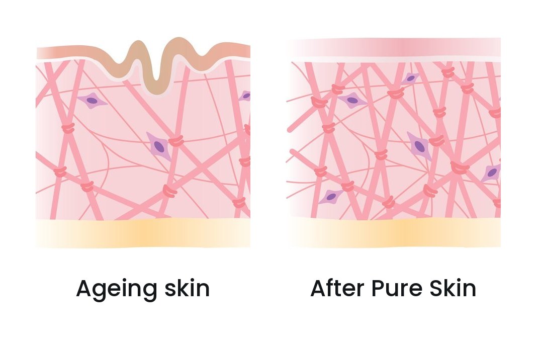 Collagène et élastine avant et après Pure Skin – Pure Skin, chirurgie esthétique et médecine régénérative du Dr Smarrito