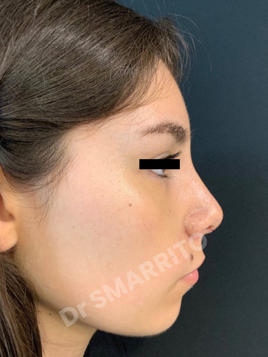 Rhinoplastie après : profil, bosse et pointe, Dr Smarrito, chirurgie esthétique à Vevey
