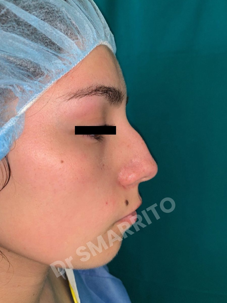 Rhinoplastie avant : profil, bosse et pointe, Dr Smarrito, chirurgie esthétique à Vevey