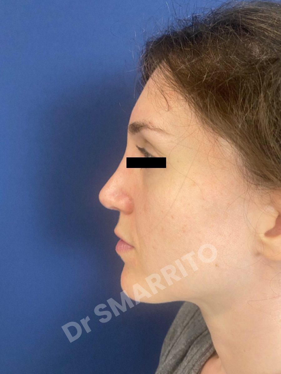 Rhinoplastie après : profil, dos du nez, Dr Smarrito, chirurgie esthétique à Vevey