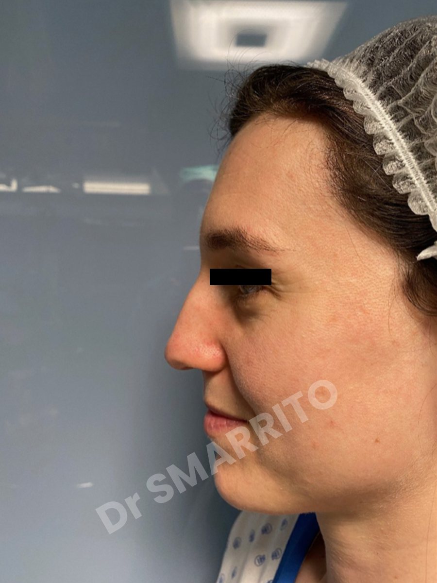 Rhinoplastie avant : profil, dos du nez, Dr Smarrito, chirurgie esthétique à Vevey