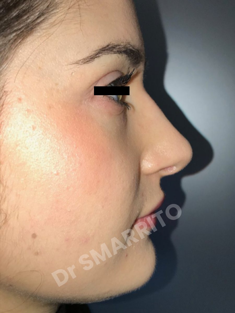 Rhinoplastie après : profil, bosse du nez, Dr Smarrito, chirurgie esthétique à Vevey