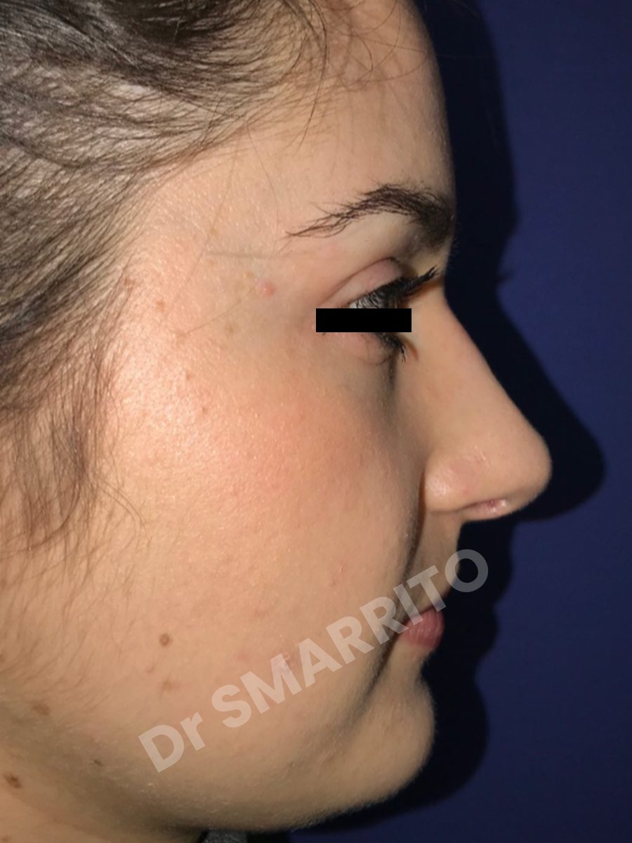 Rhinoplastie avant : profil, bosse du nez, Dr Smarrito, chirurgie esthétique à Vevey