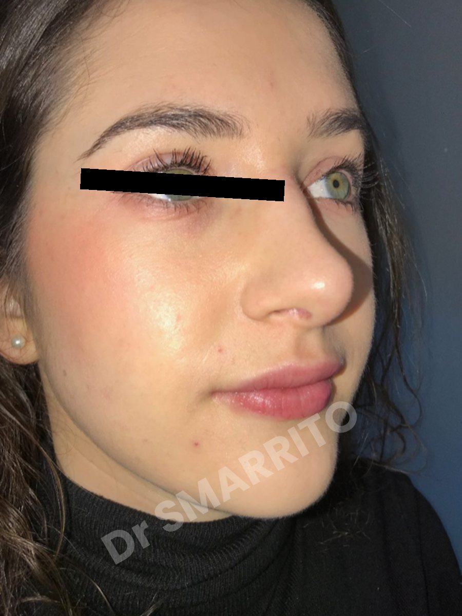 Rhinoplastie après : trois-quarts, pointe du nez, Dr Smarrito, chirurgie esthétique à Vevey