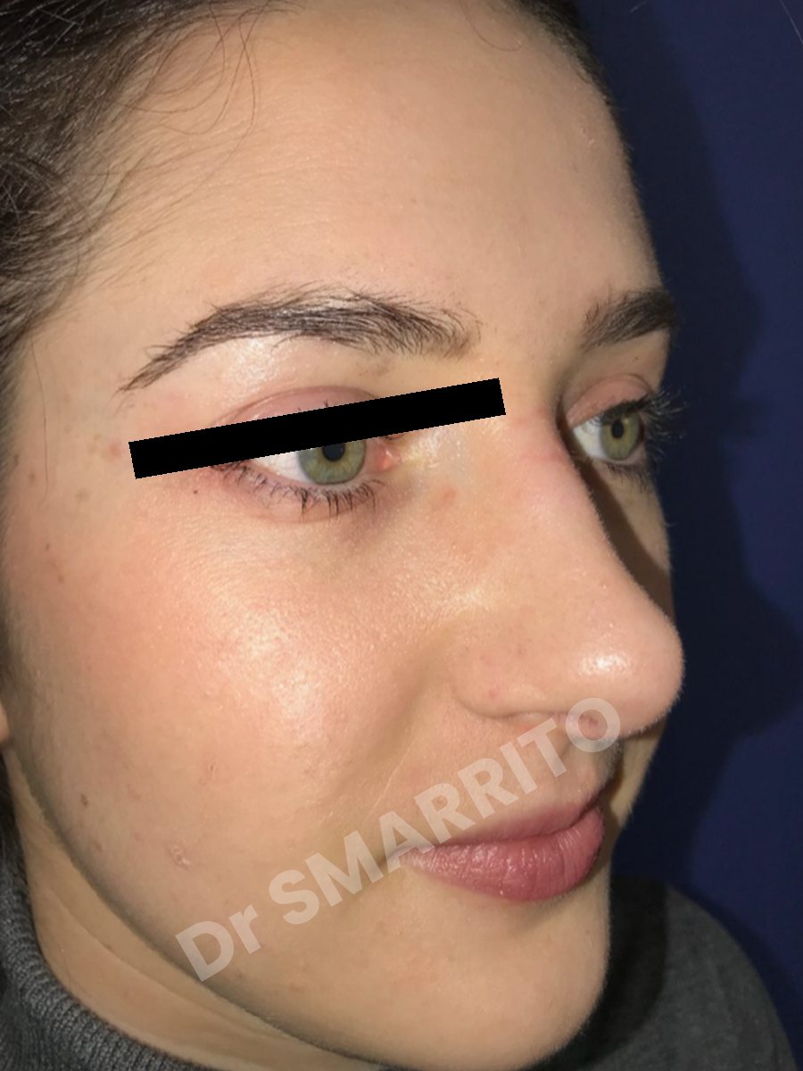 Rhinoplastie avant : trois-quarts, pointe du nez, Dr Smarrito, chirurgie esthétique à Vevey