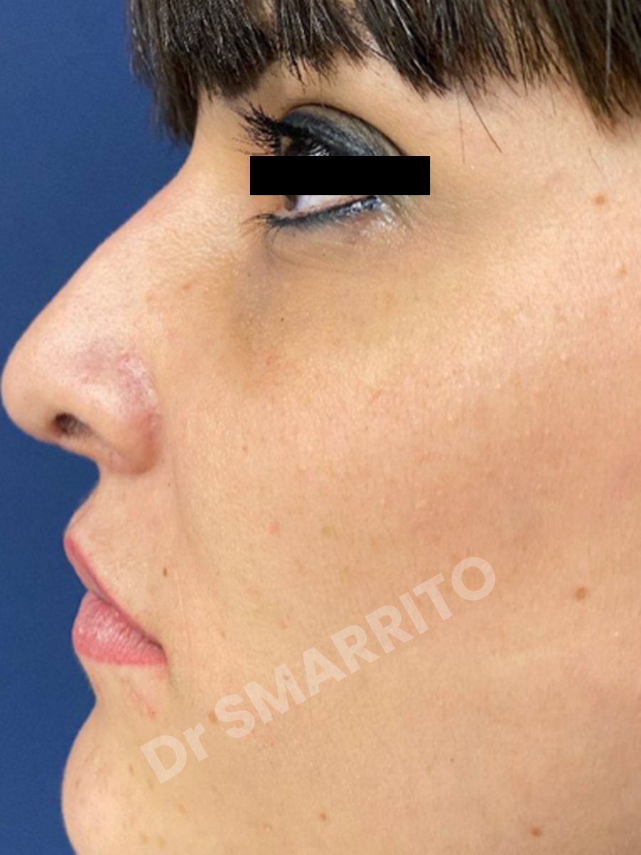 Rhinoplastie après : profil, dos et pointe, Dr Smarrito, chirurgie esthétique à Vevey