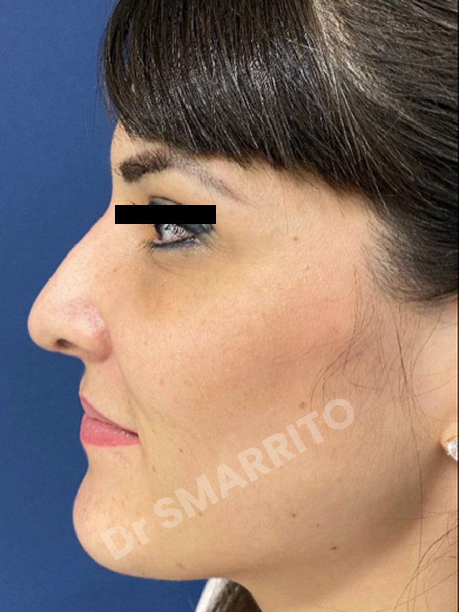 Rhinoplastie avant : profil, dos et pointe, Dr Smarrito, chirurgie esthétique à Vevey