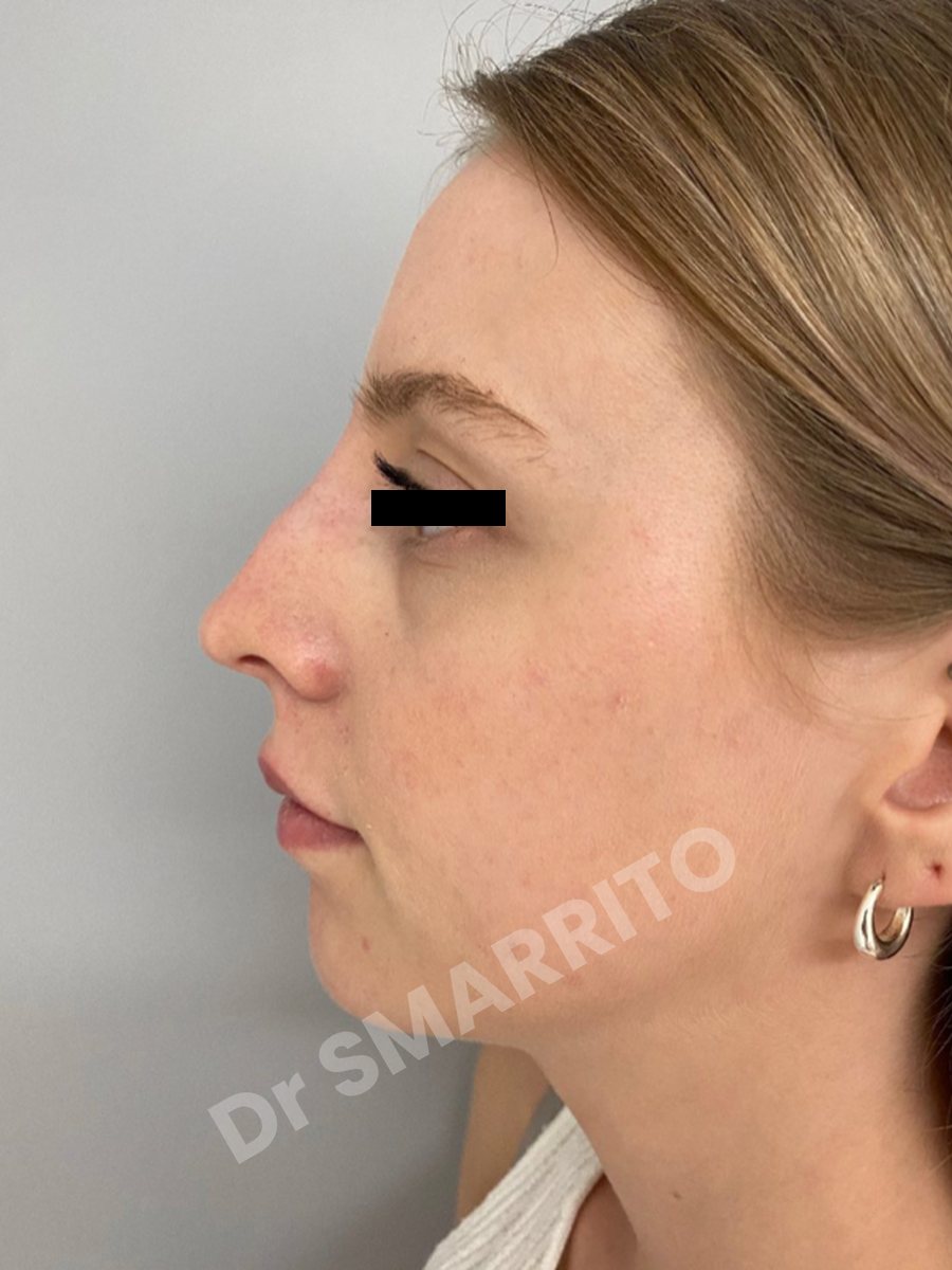 Rhinoplastie après : profil, dos du nez, Dr Smarrito, chirurgie esthétique à Vevey