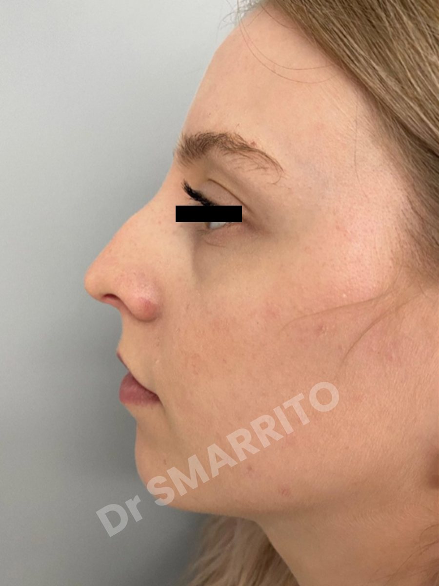 Rhinoplastie avant : profil, dos du nez, Dr Smarrito, chirurgie esthétique à Vevey