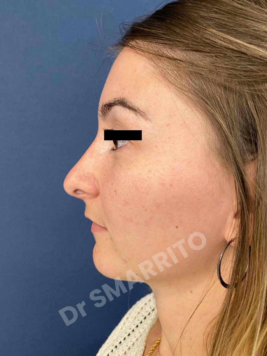 Rhinoplastie après : profil, ligne du nez, Dr Smarrito, chirurgie esthétique à Vevey