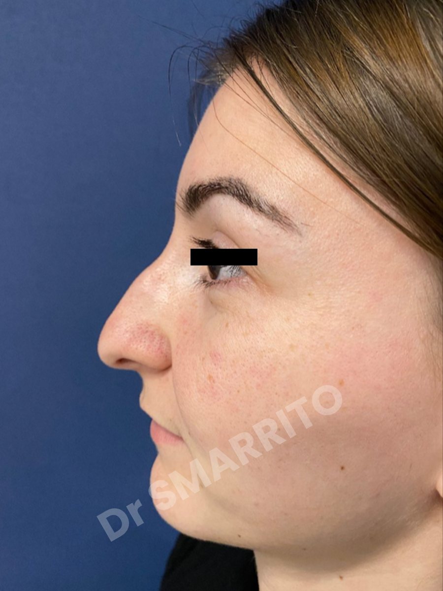 Rhinoplastie avant : profil, ligne du nez, Dr Smarrito, chirurgie esthétique à Vevey
