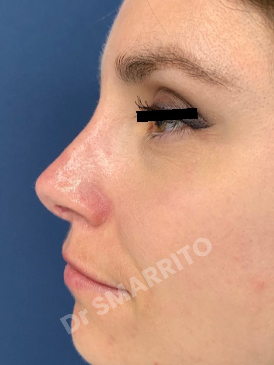 Rhinoplastie après : profil, dos du nez, Dr Smarrito, chirurgie esthétique à Vevey