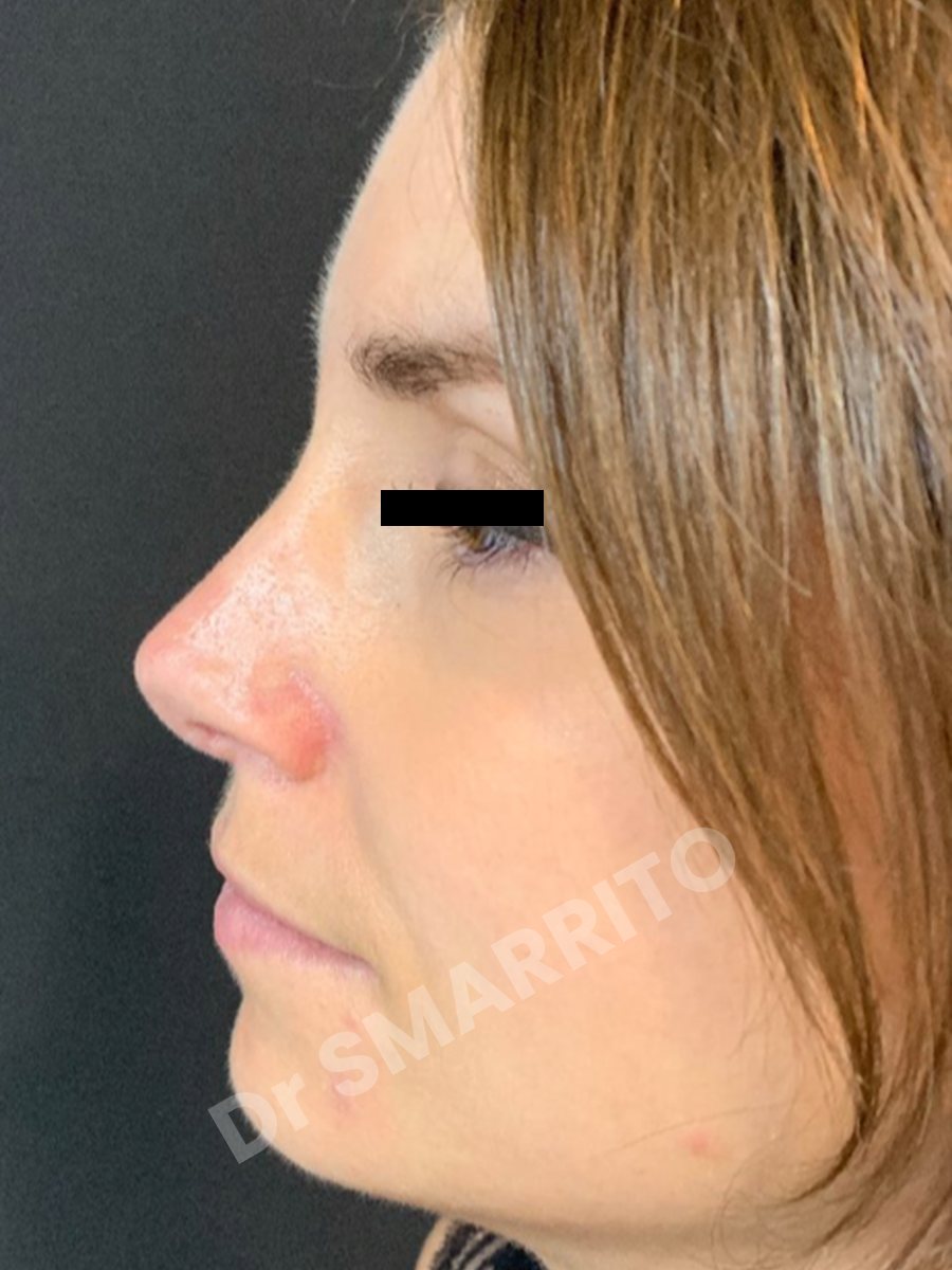 Rhinoplastie avant : profil, dos du nez, Dr Smarrito, chirurgie esthétique à Vevey