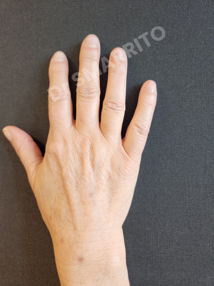 Après : taches du dos de la main, laser Dr Smarrito, chirurgie esthétique et laser à Vevey