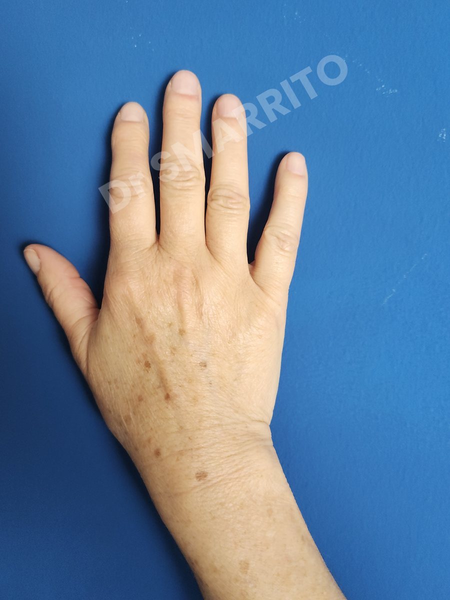 Avant : taches du dos de la main, laser Dr Smarrito, chirurgie esthétique et laser à Vevey