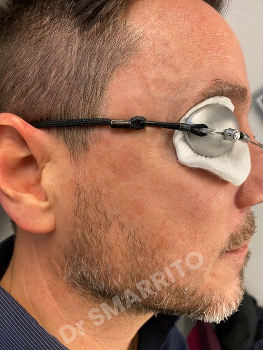 Après : tache brune de la tempe, laser Dr Smarrito, chirurgie esthétique et laser à Vevey