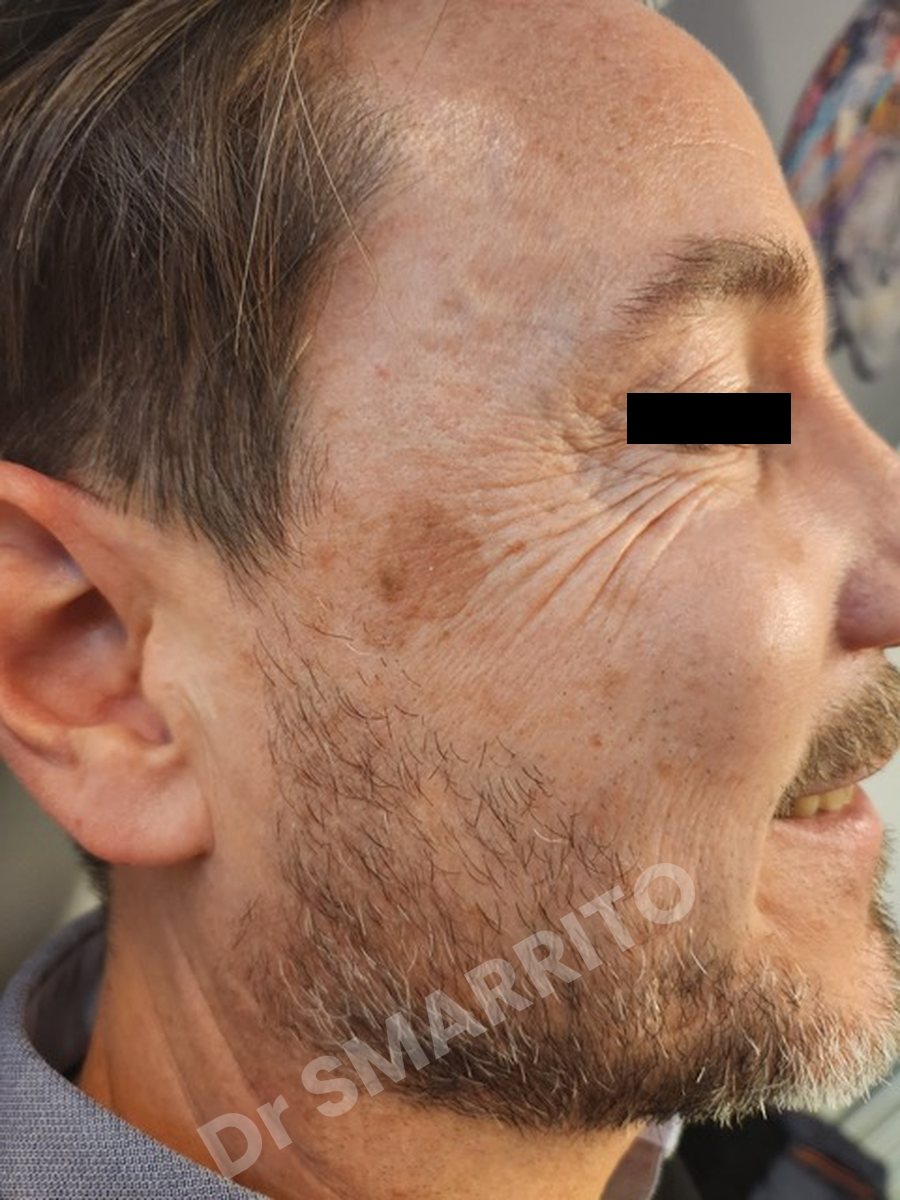 Avant : tache brune de la tempe, laser Dr Smarrito, chirurgie esthétique et laser à Vevey