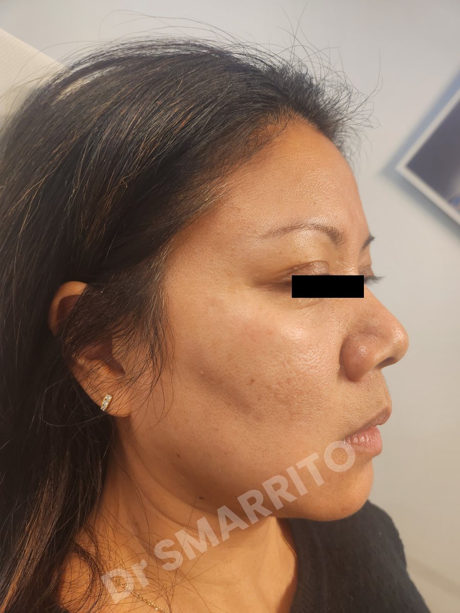Après : taches de la joue, laser Dr Smarrito, chirurgie esthétique et laser à Vevey