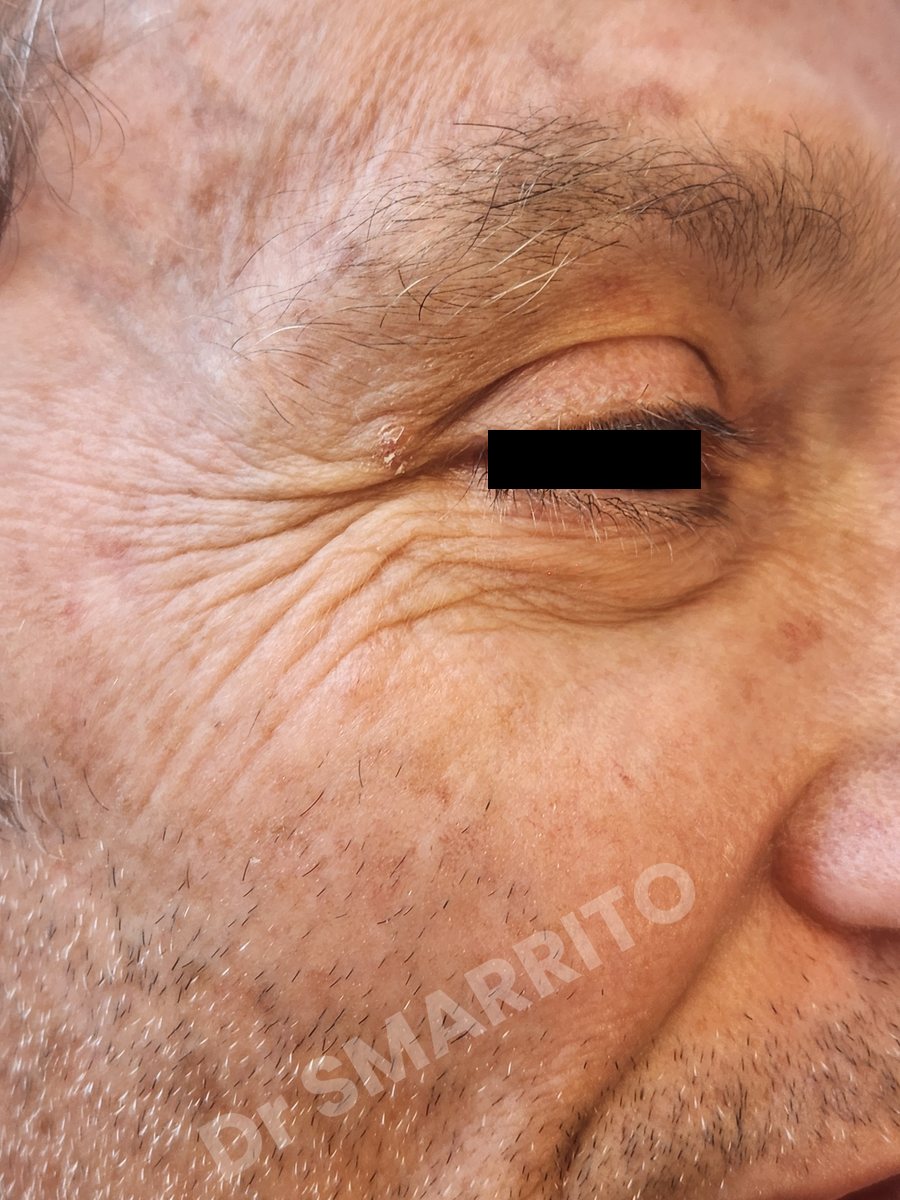 Après : lentigo de la joue, laser Dr Smarrito, chirurgie esthétique et laser à Vevey
