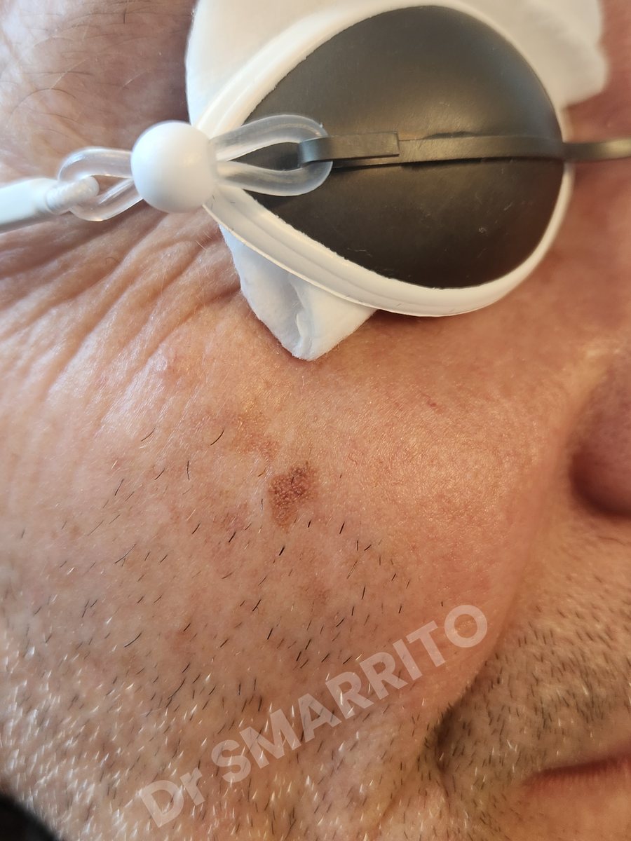 Avant : lentigo de la joue, laser Dr Smarrito, chirurgie esthétique et laser à Vevey