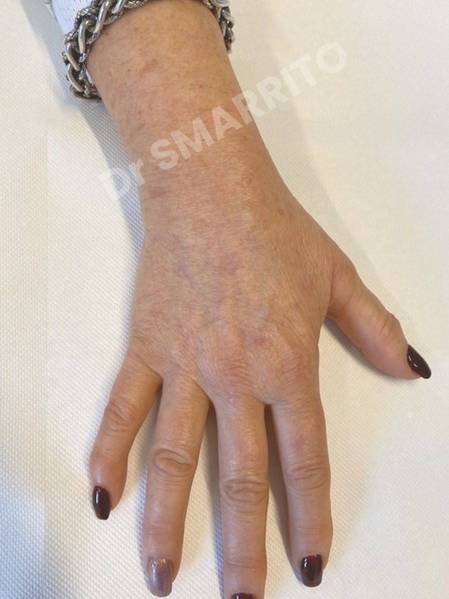 Après : taches du dos de la main, laser Dr Smarrito, chirurgie esthétique et laser à Vevey