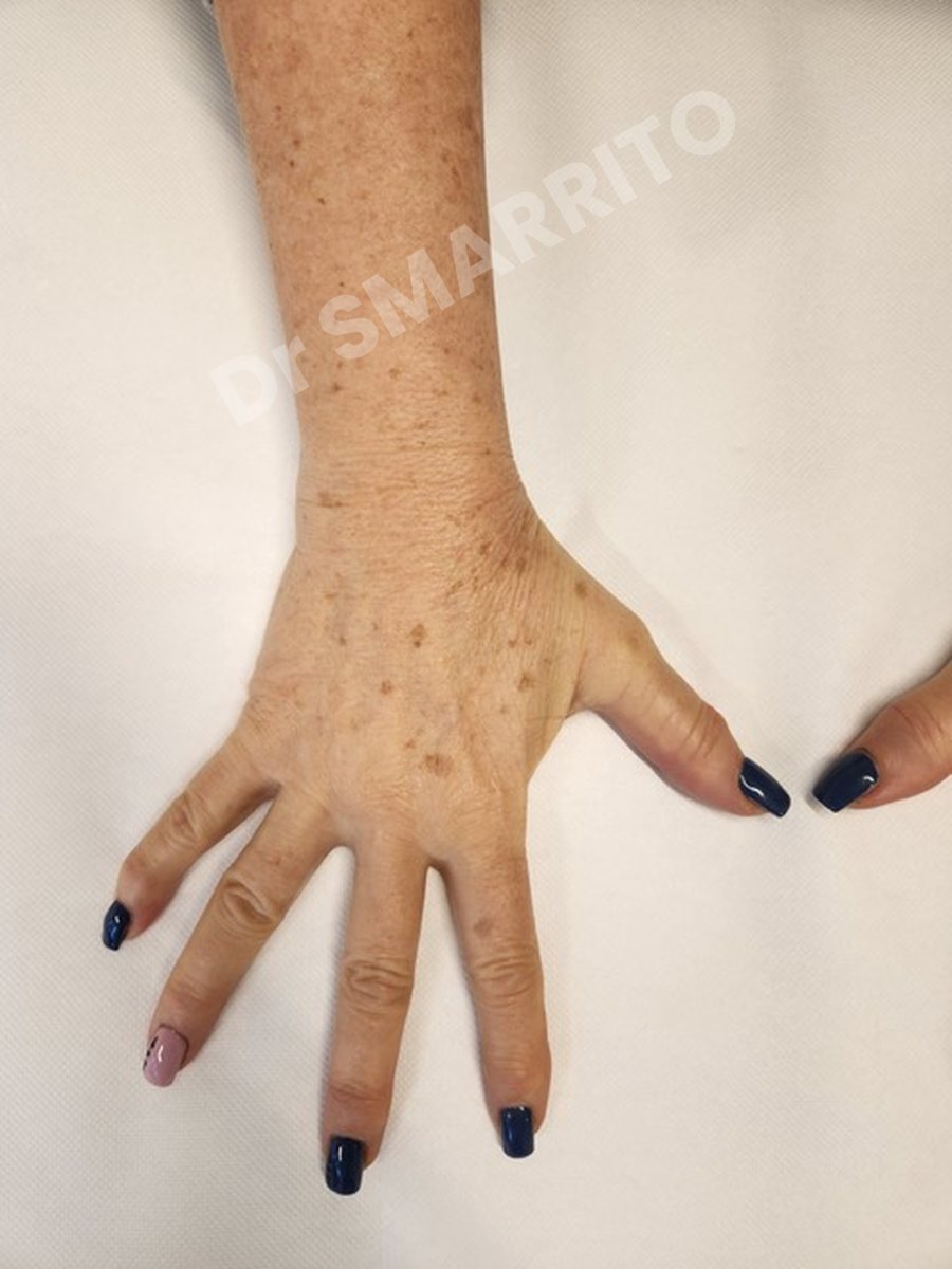Avant : taches du dos de la main, laser Dr Smarrito, chirurgie esthétique et laser à Vevey