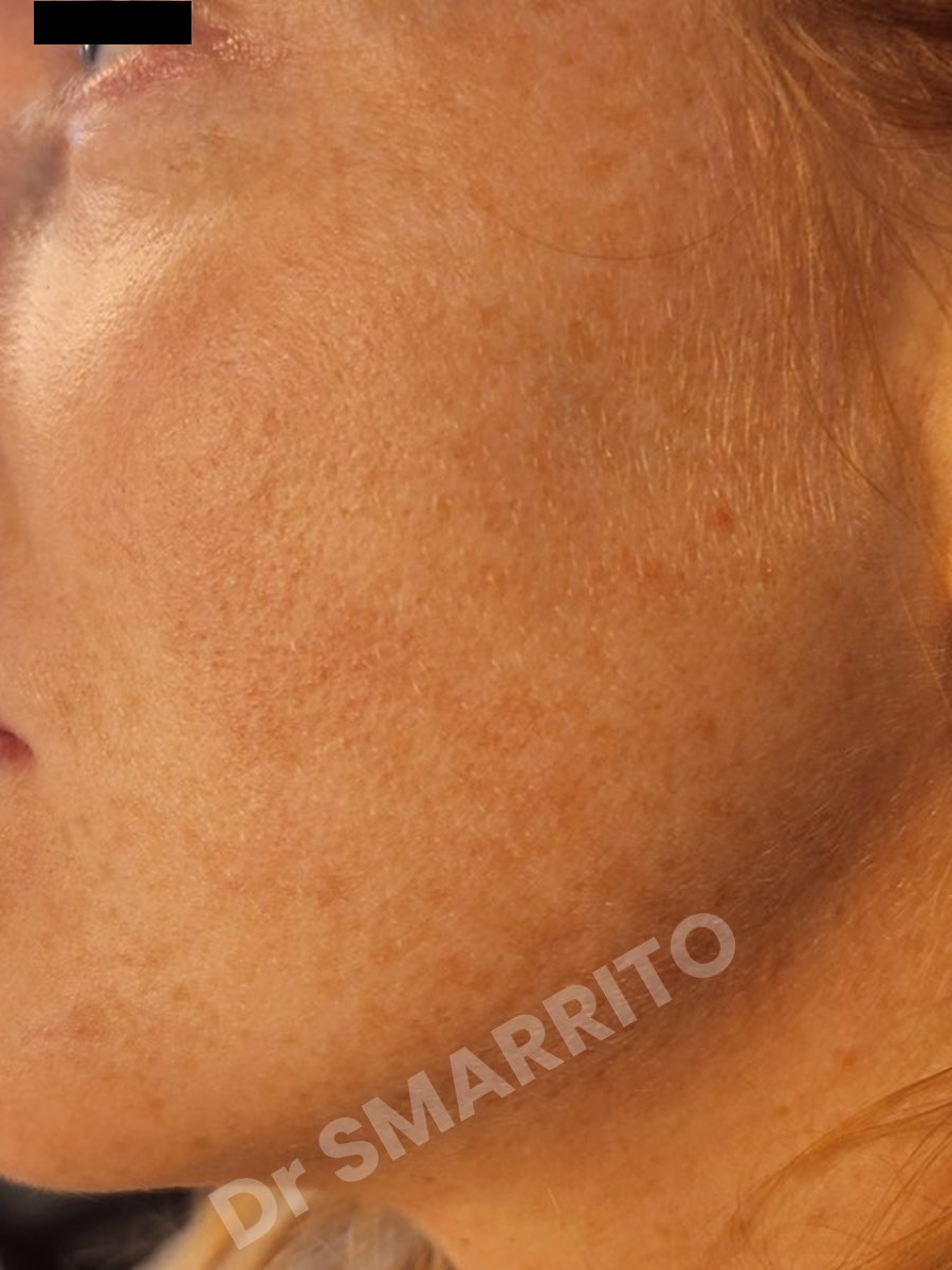 Après : taches de la pommette, laser Dr Smarrito, chirurgie esthétique et laser à Vevey
