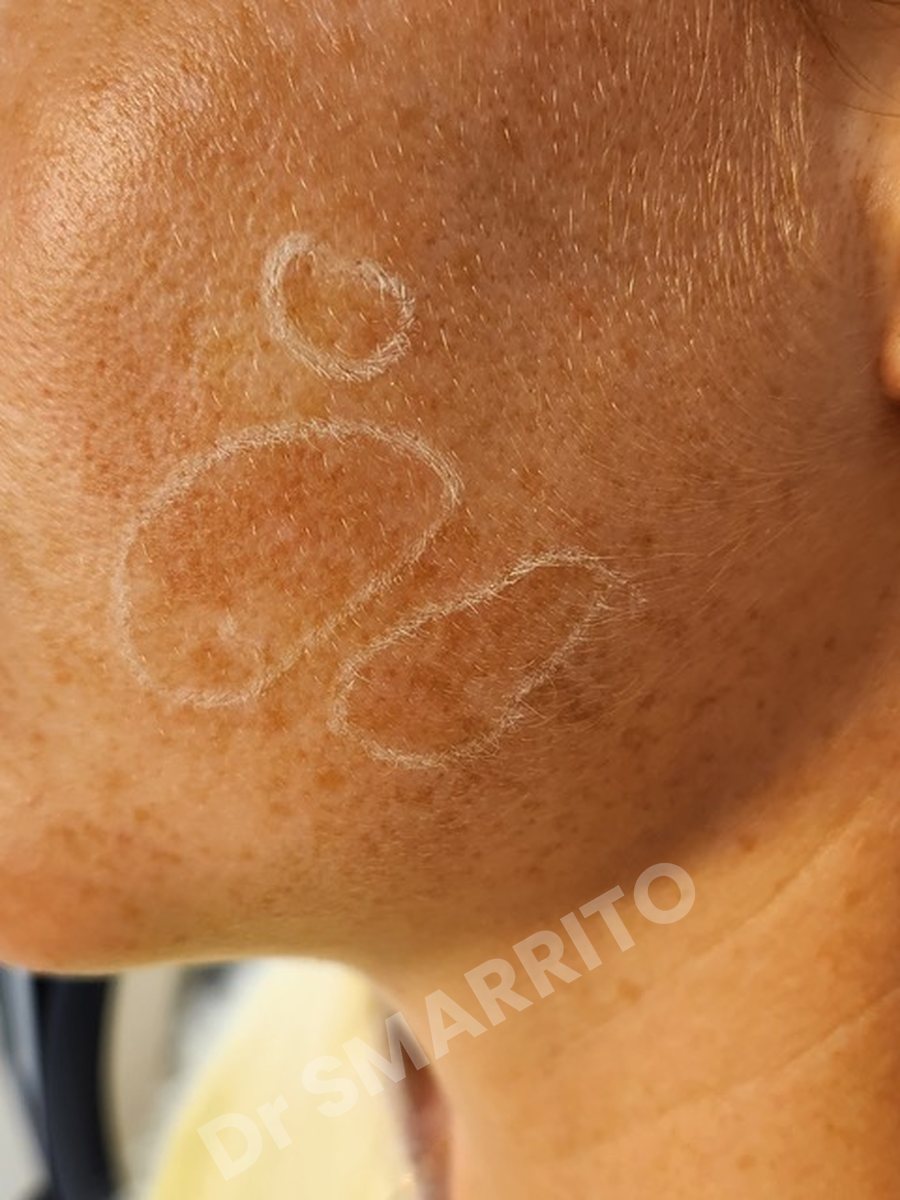 Avant : taches de la pommette, laser Dr Smarrito, chirurgie esthétique et laser à Vevey