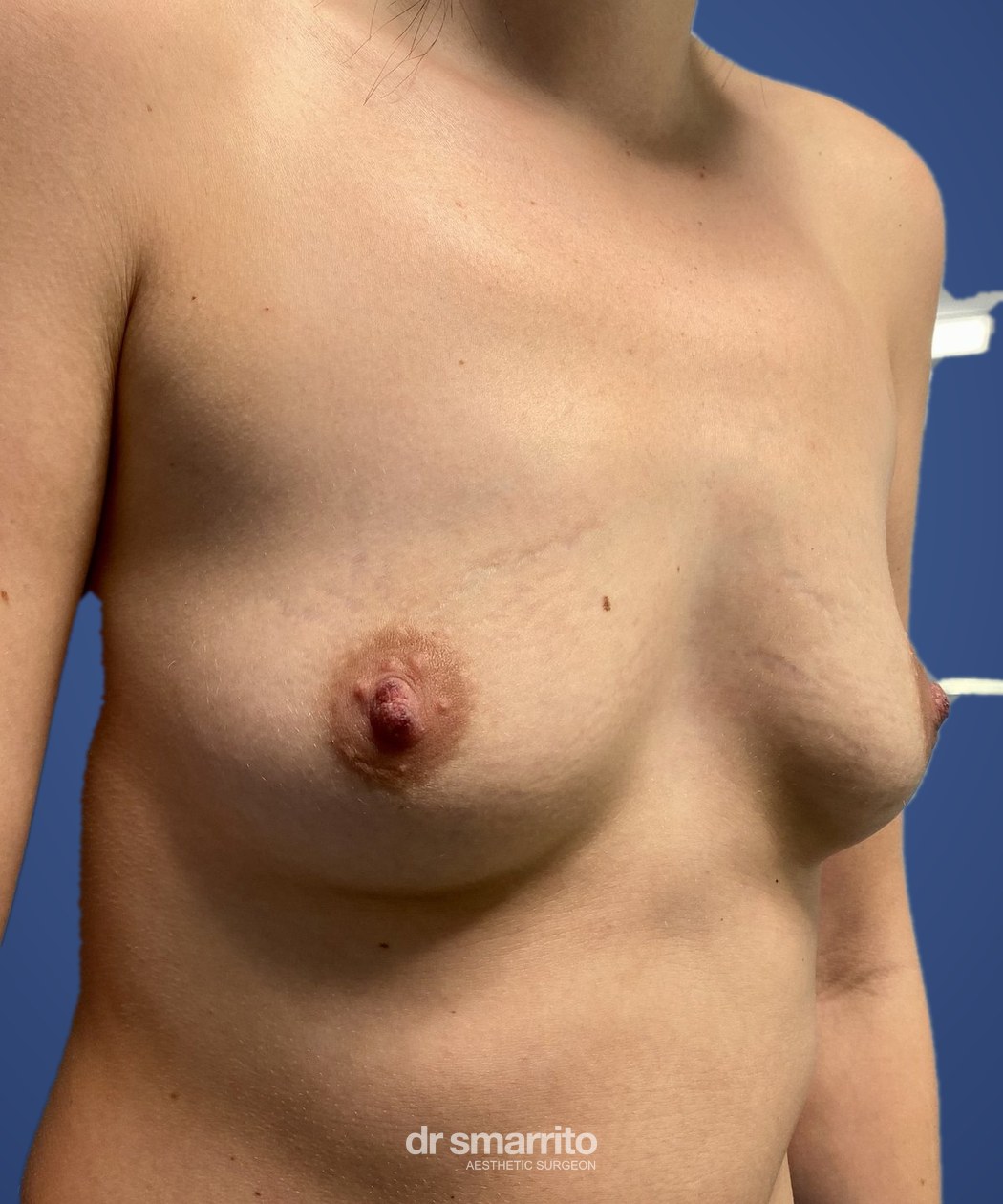 Avant augmentation mammaire de trois-quarts – chirurgie esthétique Dr Smarrito