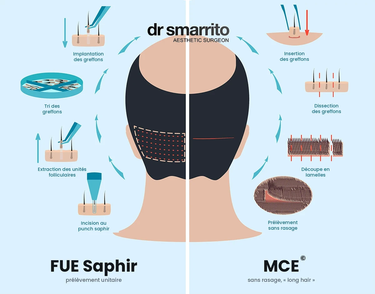 Comparaison FUE Saphir et MCE en greffe de cheveux – chirurgie esthétique Dr Smarrito