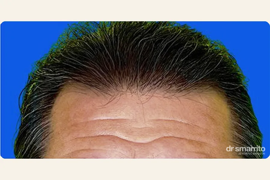 Après greffe de cheveux MCE sans rasage – chirurgie esthétique Dr Smarrito