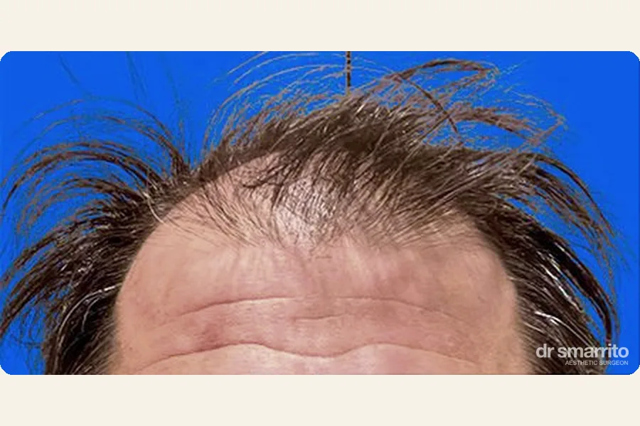 Avant greffe de cheveux MCE sans rasage – chirurgie esthétique Dr Smarrito