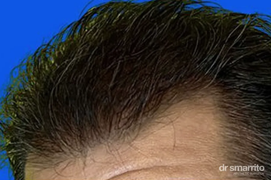 Après greffe de cheveux des golfes – chirurgie esthétique Dr Smarrito