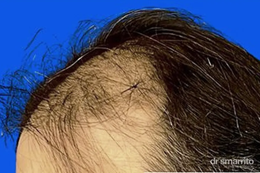 Avant greffe de cheveux des golfes, vue de profil – chirurgie esthétique Dr Smarrito