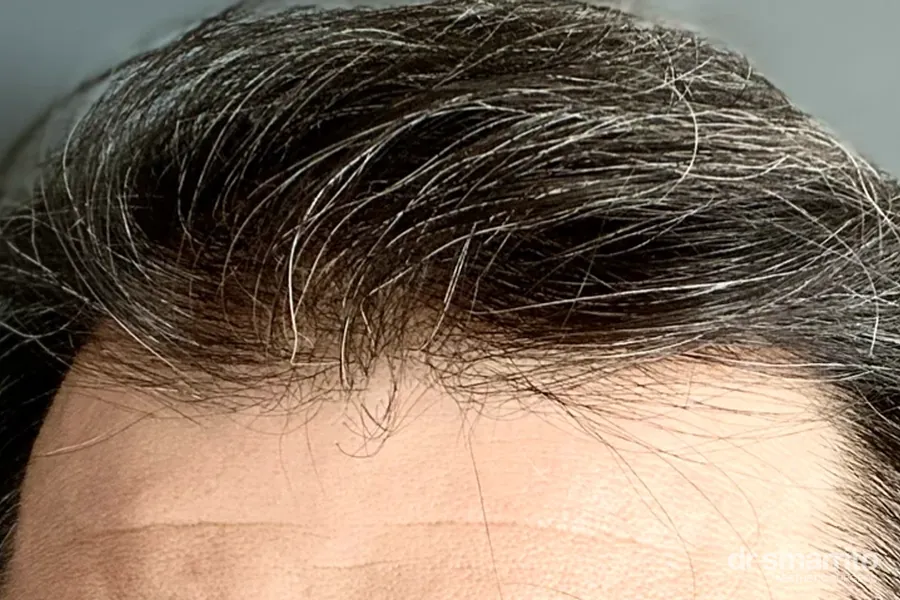 Après greffe de cheveux, cheveux blancs panachés – chirurgie esthétique Dr Smarrito