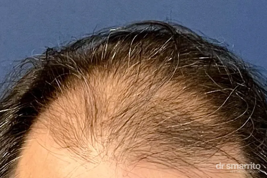 Avant greffe de cheveux, front dégarni – chirurgie esthétique Dr Smarrito