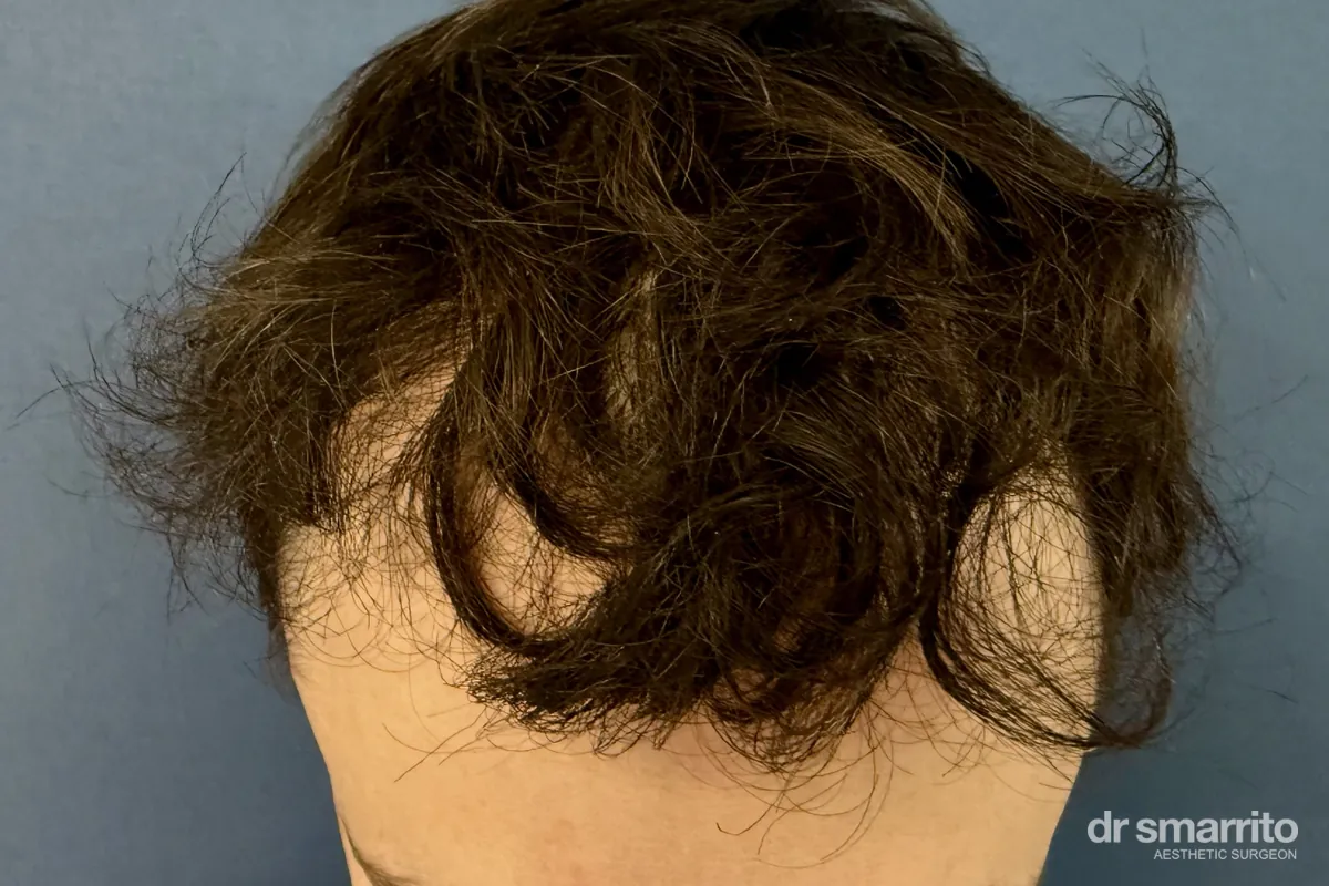 Après greffe de cheveux sans raser, 14 mois, vue de dessus – chirurgie esthétique Dr Smarrito