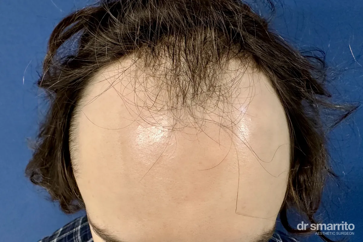 Avant greffe de cheveux sans raser, vue de dessus – chirurgie esthétique Dr Smarrito