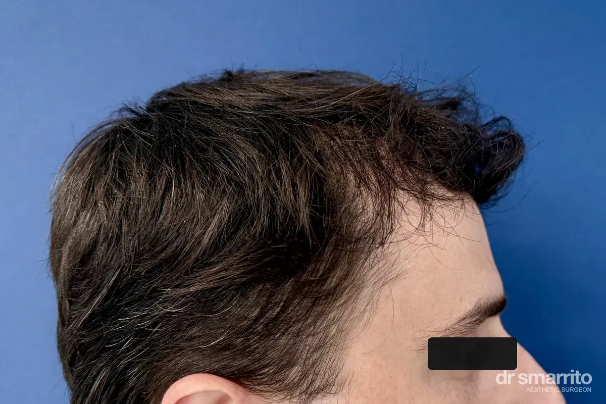 Après greffe de cheveux sans raser, 14 mois, profil – chirurgie esthétique Dr Smarrito