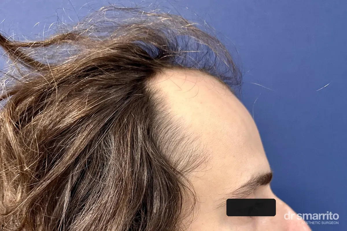 Avant greffe de cheveux sans raser, profil – chirurgie esthétique Dr Smarrito